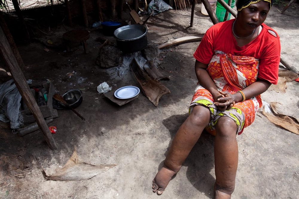 Photo of a woman with lymphatic filariasis